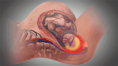 image of head impaction during birth